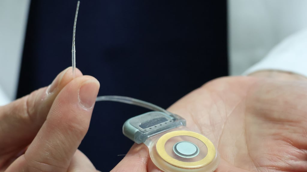 Ein feines Band mit Elektroden wird in der Hörschnecke platziert und schafft die Verbindung zum Hörnerv. Der Impulsgeber wird in eine Schädelmulde unter die Haut verpflanzt.