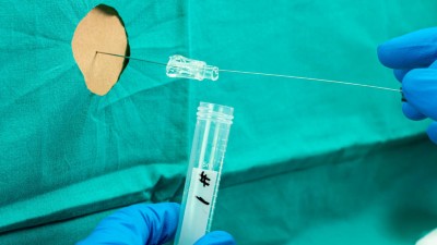 Metaanalyse bestätigt: pTau217 ist der beste Alzheimer-Serum-Marker
