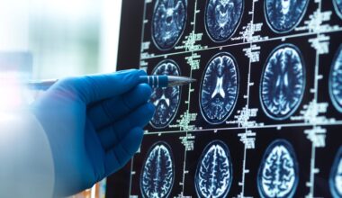 Alzheimer im Frühstadium: Neue Behandlung an Uniklinik Freiburg
