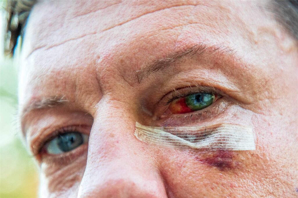 Ein Gesichtsausschnitt des Mannes, der geschlagen wurde, rund zwei Wochen nach dem Vorfall am 6. September 2025.