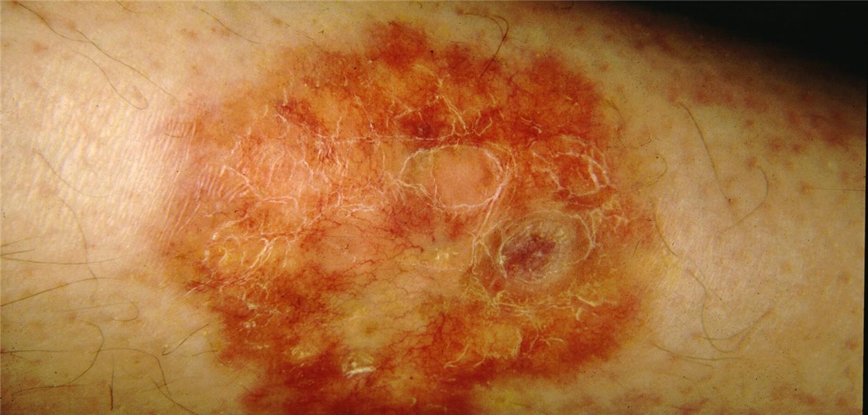 Was tun, wenn beim Diabetes die Haut Ärger macht?