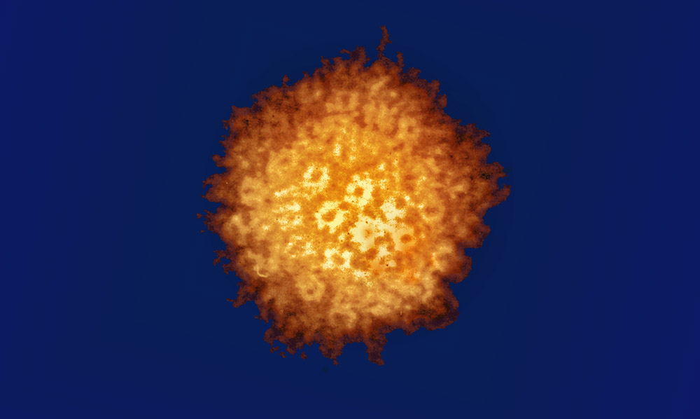 Herpes simplex