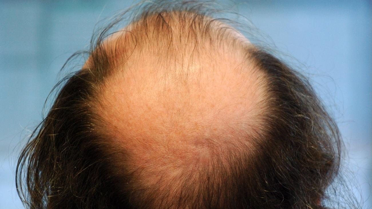 Elbvertiefung: Der tägliche Newsletter aus Hamburg: Wenn plötzlich die Haare weg sind