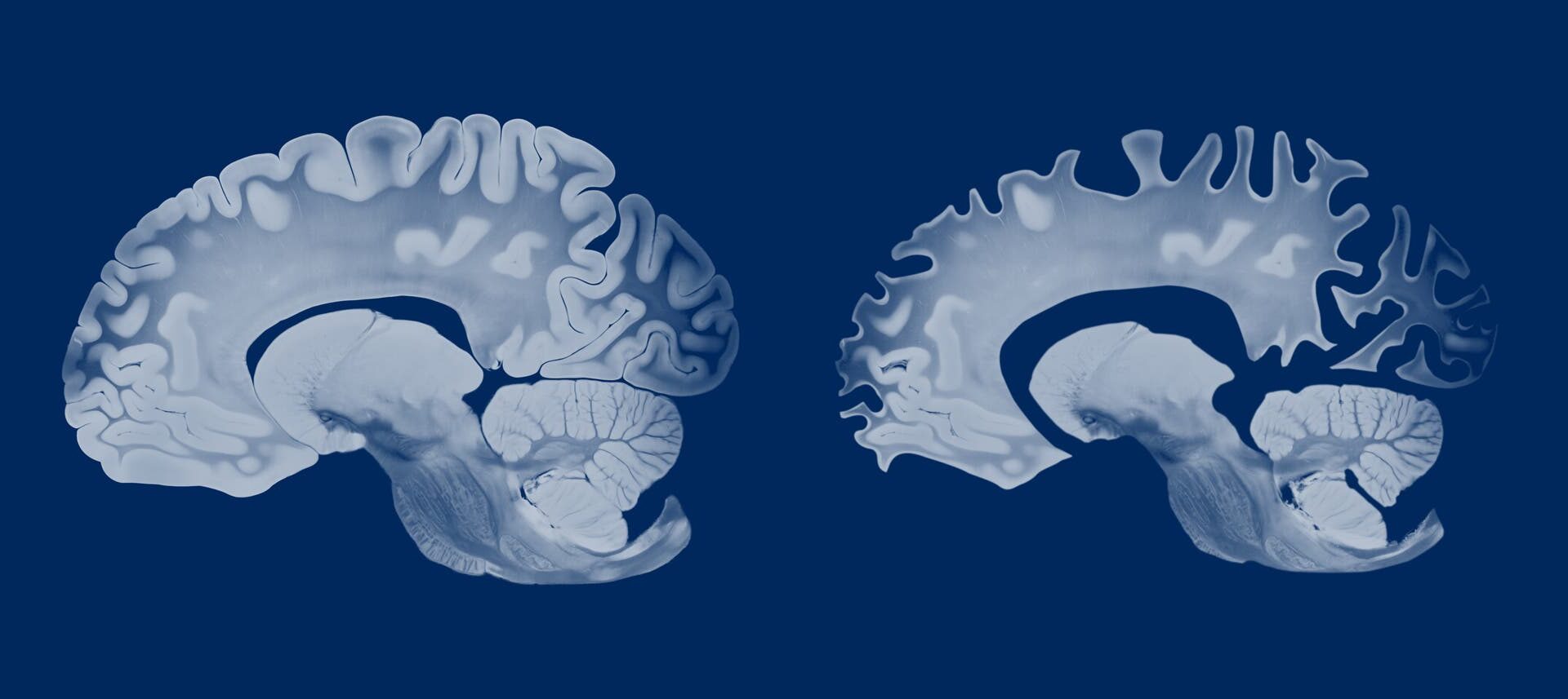 Zwei anatomische Diagramme von Gehirnen im Querschnitt, die die Struktur und Anordnung der Gehirnwindungen und -furchen zeigen. Die Abbildungen heben die Unterschiede in der Komplexität der Oberflächenstruktur hervor. Die Darstellung ist in Blautönen gehalten, um die Details der Gehirnanatomie zu betonen.