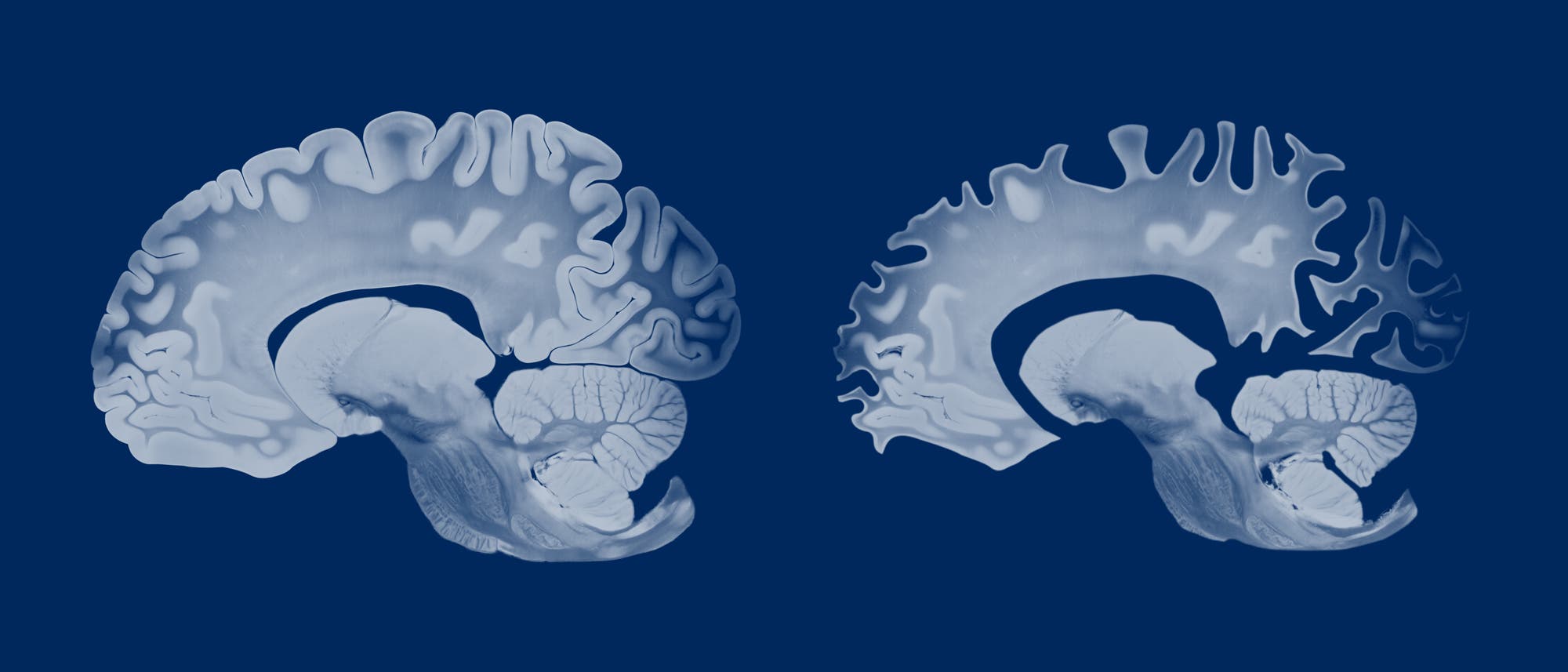 Zwei anatomische Diagramme von Gehirnen im Querschnitt, die die Struktur und Anordnung der Gehirnwindungen und -furchen zeigen. Die Abbildungen heben die Unterschiede in der Komplexität der Oberflächenstruktur hervor. Die Darstellung ist in Blautönen gehalten, um die Details der Gehirnanatomie zu betonen. Zwei anatomische Diagramme von Gehirnen im Querschnitt, die die Struktur und Anordnung der Gehirnwindungen und -furchen zeigen. Die Abbildungen heben die Unterschiede in der Komplexität der Oberflächenstruktur hervor. Die Darstellung ist in Blautönen gehalten, um die Details der Gehirnanatomie zu betonen.