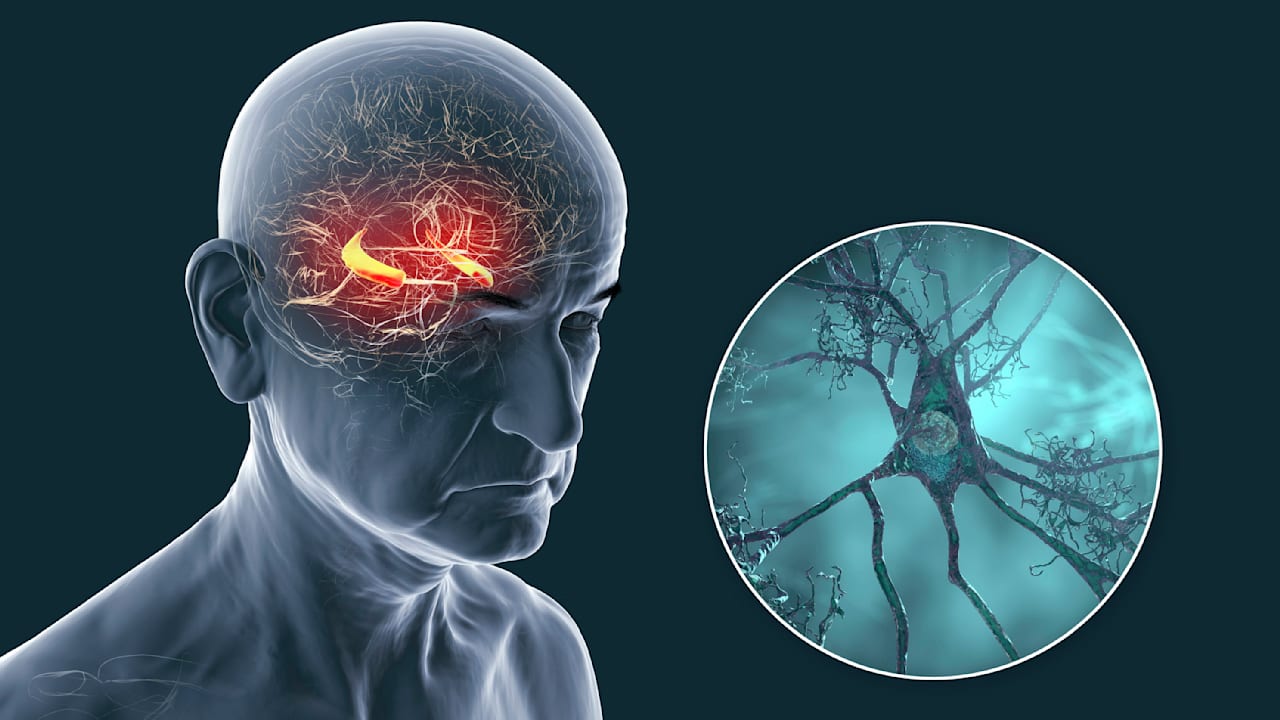 Alzheimer-Forschung: Protein hilft beim Kampf gegen Krebs | Leben & Wissen