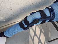 mehr Arthrose und mehr Risiken beim Knie- und Hüftgelenksersatz