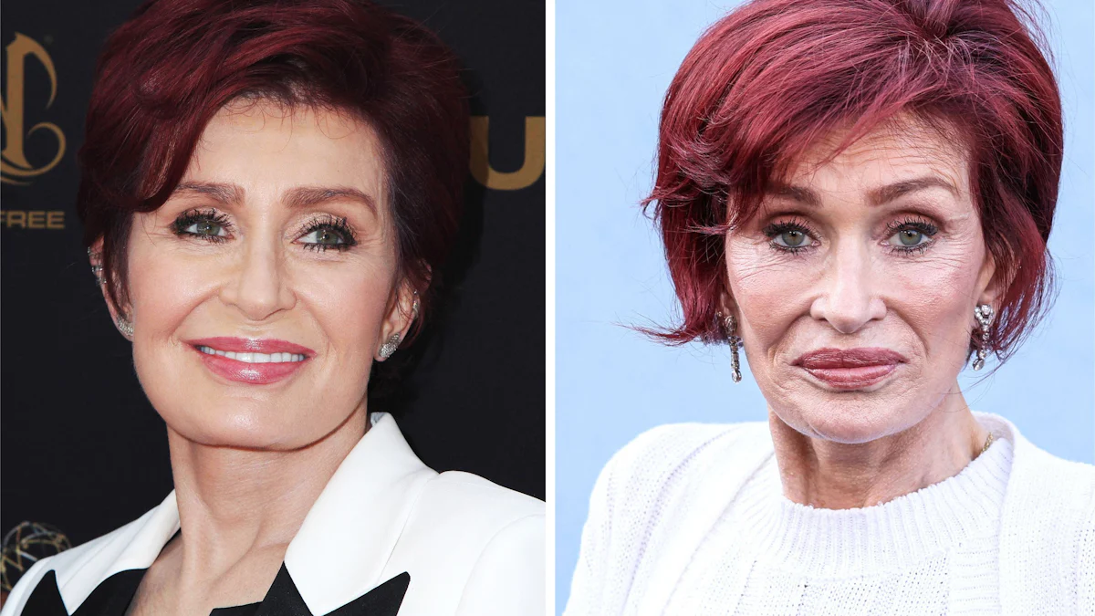 Ozempic-Face mit hohlen Wangen und Falten: Droht nach dem Gewichtsverlust der Gesichtsverlust? - Panorama