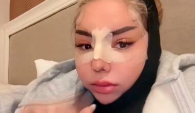 „Sommerhaus“-Star Emma Fernlund: Neues Gesicht nach OP-Marathon | Unterhaltung