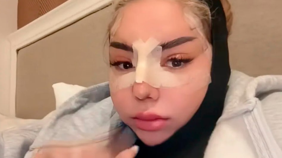 „Sommerhaus“-Star Emma Fernlund: Neues Gesicht nach OP-Marathon | Unterhaltung