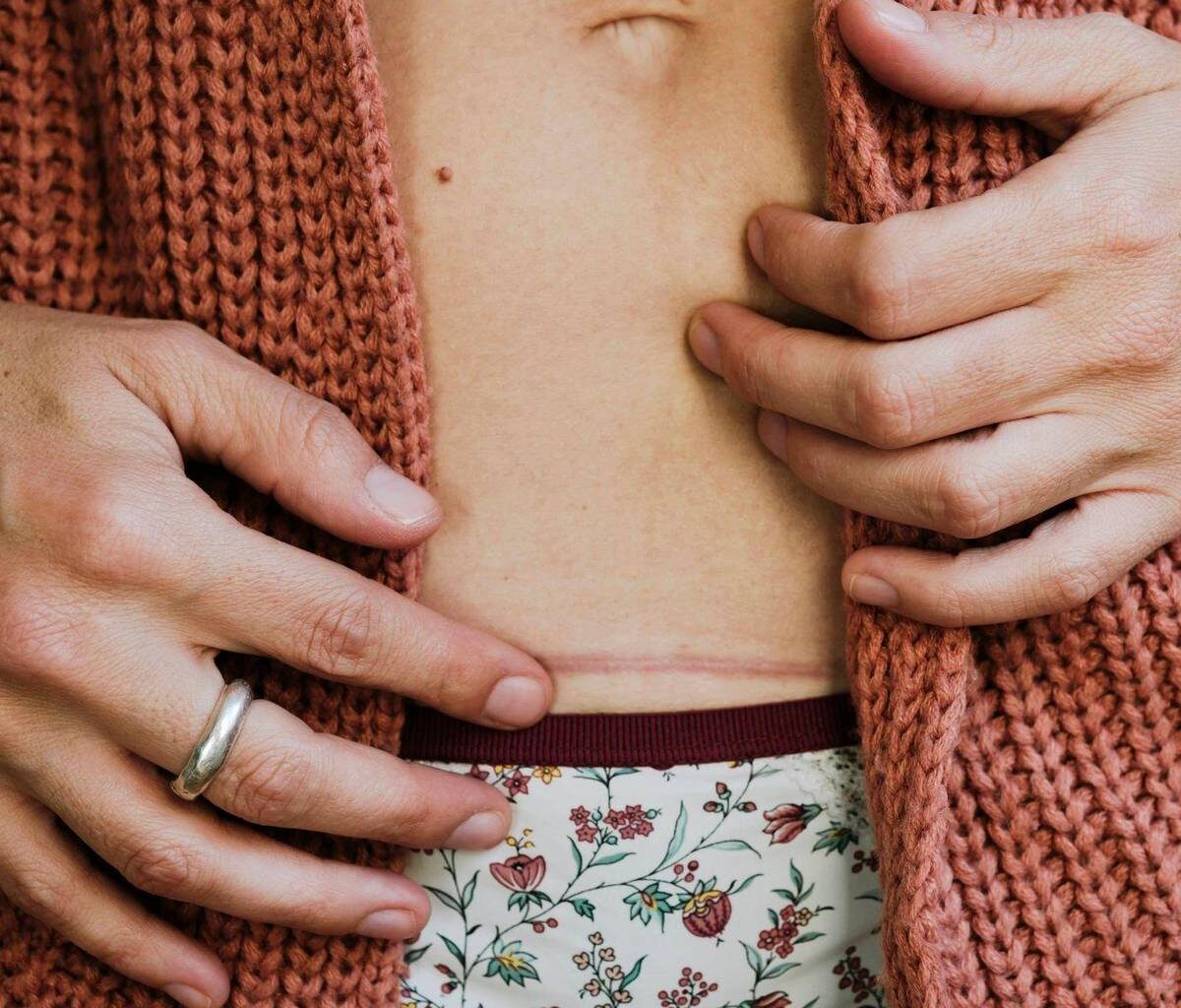 Worauf es bei der Pflege von Narben ankommt