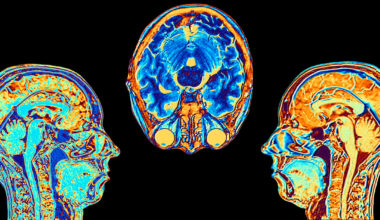 „Der Brain Age Gap zeigt, wer gefährdet ist – noch bevor Demenz beginnt“ - WELT