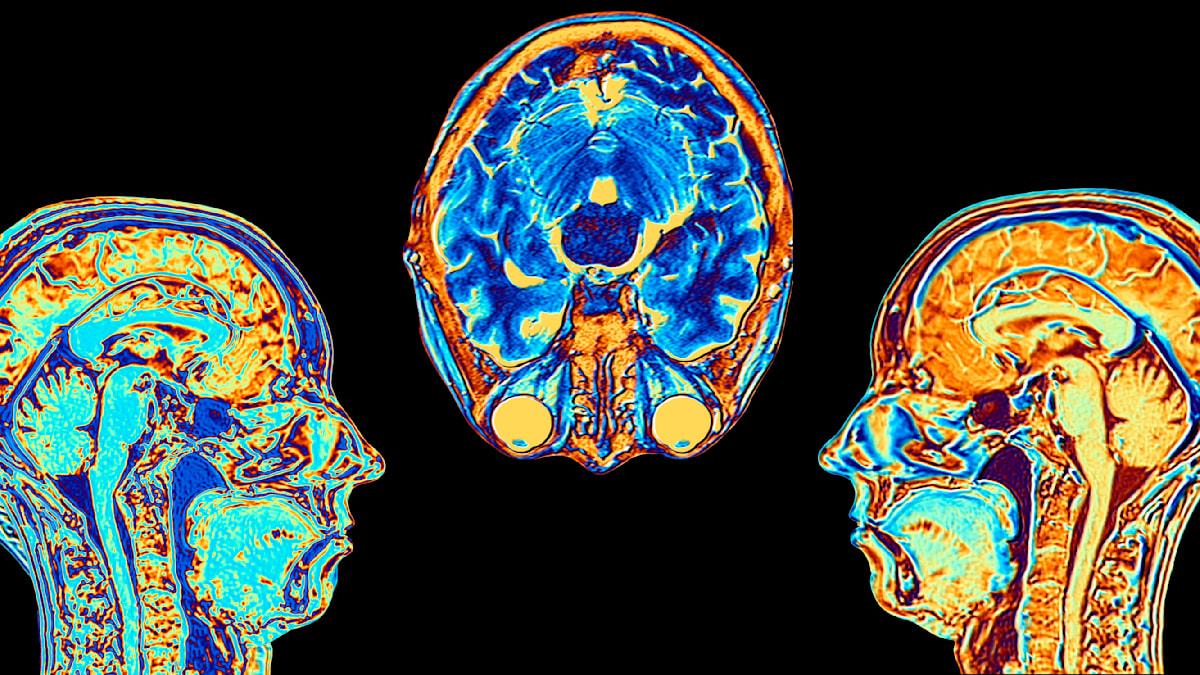 „Der Brain Age Gap zeigt, wer gefährdet ist – noch bevor Demenz beginnt“ - WELT