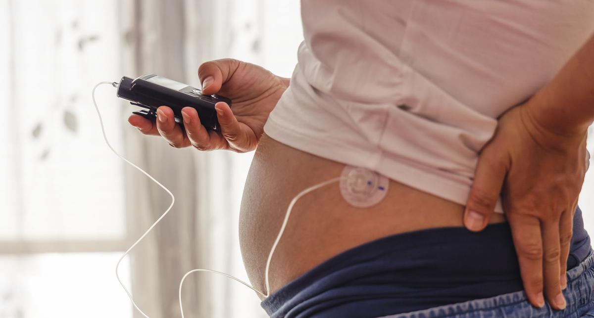 Hybrid-Closed-Loop-System verbessert Blutzuckerkontrolle in der Schwangerschaft – News – Deutsches Ärzteblatt