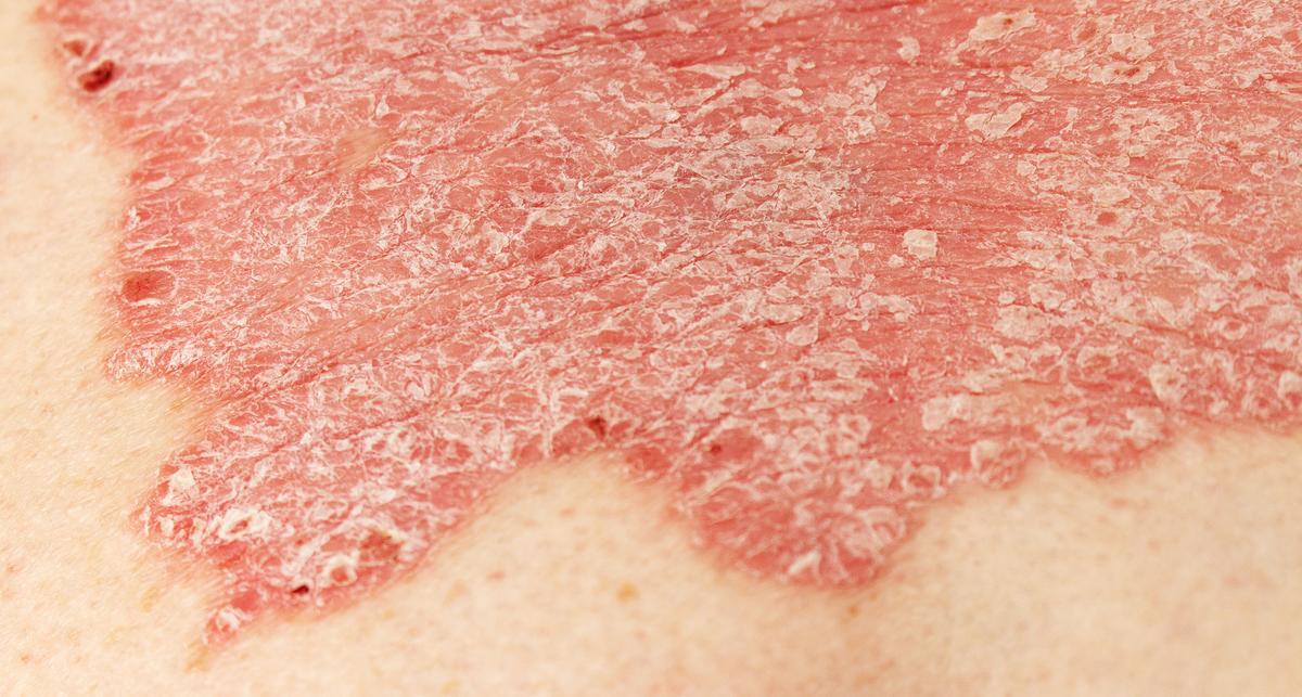 Weitere Zunahme der Krankheitsfälle bis 2050 erwartet – News – Deutsches Ärzteblatt