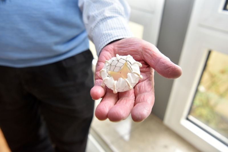 Neues Verfahren zum Herzklappenersatz erfolgreich in Bochum eingeführt