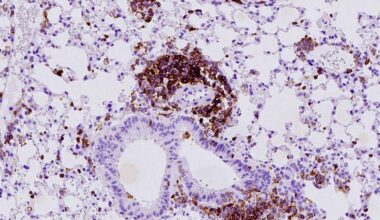 Stille Entzündung fördert eine der aggressivsten Krebsarten