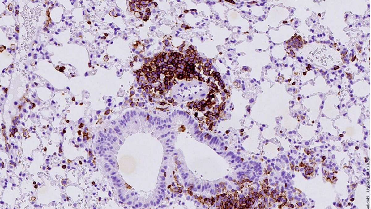 Stille Entzündung fördert eine der aggressivsten Krebsarten