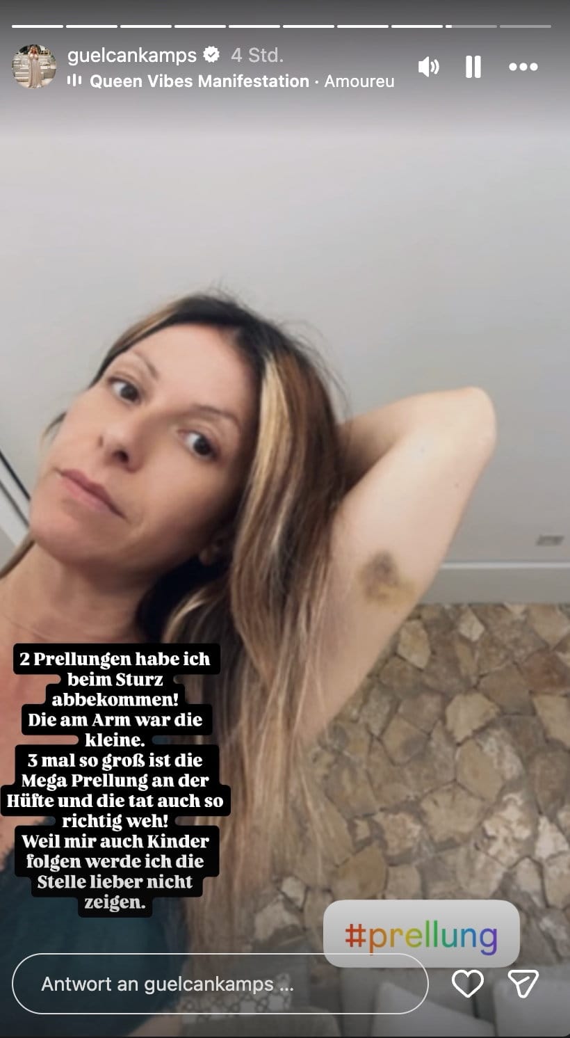 Auf Instagram zeigt Gülcan die Prellung an ihrem Arm
