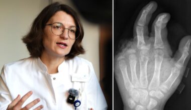 "Arbeitsreichste Nacht": Handchirurgin: Böllerverletzungen werden schlimmer