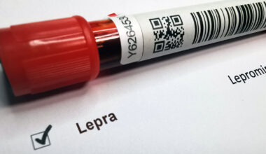 Lepra in Europa: Was Sie über die Krankheit wissen sollten