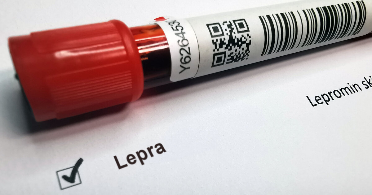 Lepra in Europa: Was Sie über die Krankheit wissen sollten