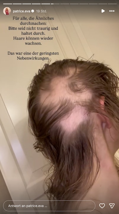 Patrice Aminati zeigt kahle Stellen an ihrem Hinterkopf. "Eine der geringen Nebenwirkungen", schreibt sie dazu.