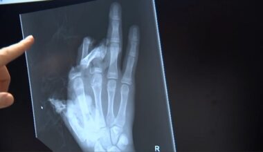 "Bei vielen dieser Kinder konnten wir die Finger nicht retten"