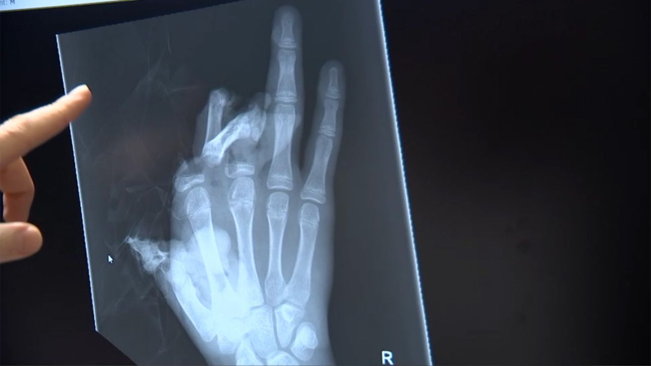 "Bei vielen dieser Kinder konnten wir die Finger nicht retten"