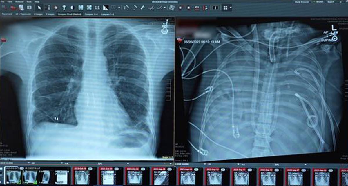 Patient überlebt 48 Stunden mit künstlicher Lunge – News – Deutsches Ärzteblatt