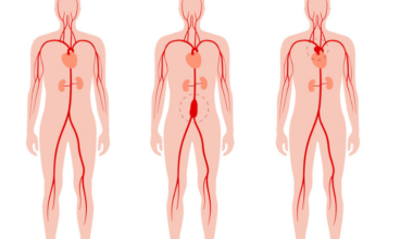 Genschalter schützt die Aorta vor Aneurysmen