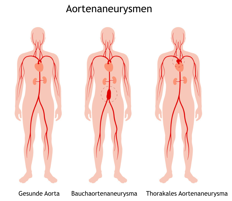 Genschalter schützt die Aorta vor Aneurysmen