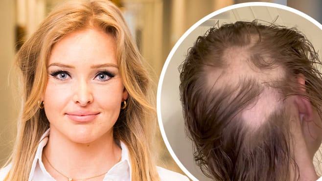 Krebskranke Patrice Aminati macht Betroffenen Mut: „Haare können wieder wachsen“ | Unterhaltung