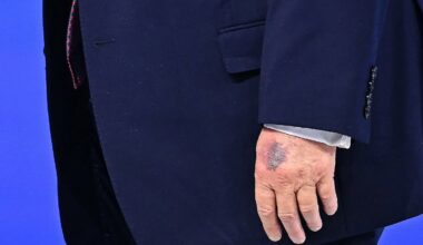 Der Tag: Weißes Haus gibt ungewöhnliche Erklärung für Bluterguss an Trumps Hand
