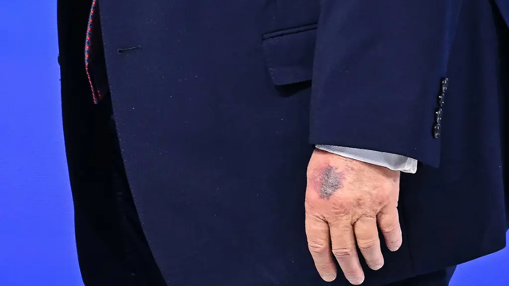 A-bruise-is-visible-on-the-back-of-US-President-Donald-Trump-s-left-hand-as-he-walks-at-the-Board-of-Peace-meeting-during-the-World-Economic-Forum-WEF-annual-meeting-in-Davos-on-January-22-2026-US-President-Donald-Trump-will-show-off-his-new-Board-of-Peace-at-Davos-on-January-22-2026-burnishing-his-claim-to-be-a-peacemaker-a-day-after-backing-off-his-own-threats-against-Greenland-Originally-meant-to-oversee-the-rebuilding-of-Gaza-after-the-war-between-Hamas-and-Israel-the-board-s-charter-does-not-limit-its-role-to-the-Strip-and-has-sparked-concerns-that-Trump-wants-it-to-rival-the-United-Nations