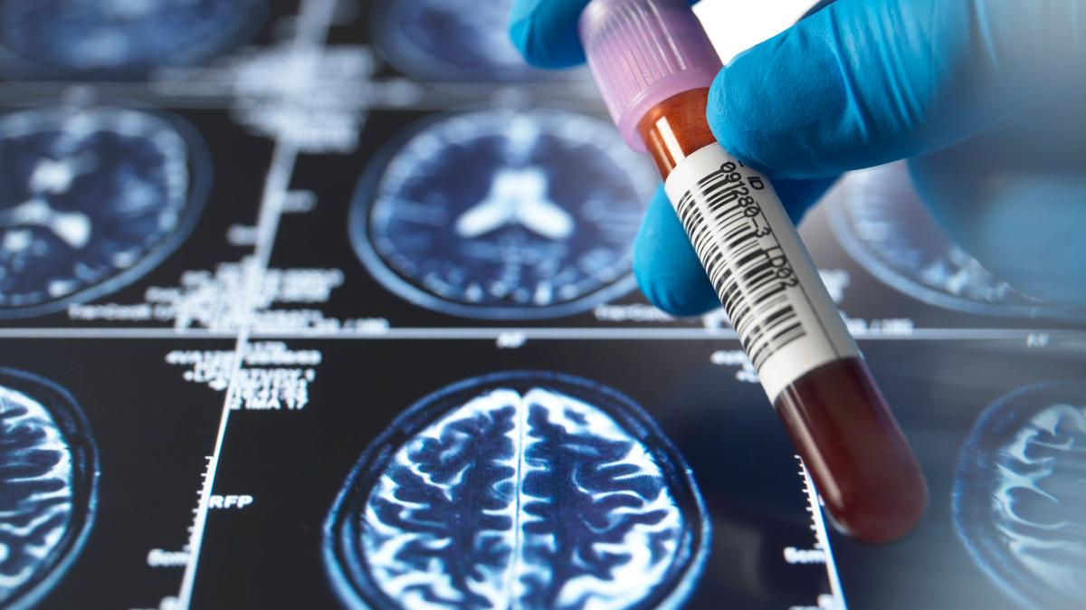 Andre Yarham: Jüngster Demenz-Patient Großbritanniens gestorben