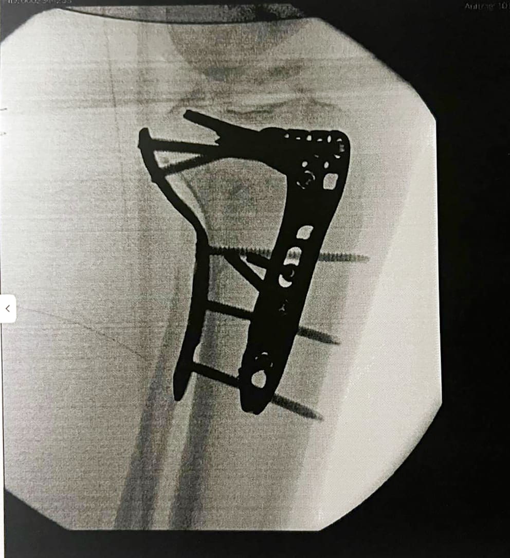 Im Röntgenbild sieht man die verheerende Verletzung nach der Operation, viele Nägel, Schrauben und Platten halten die zertrümmerten Teile zusammen