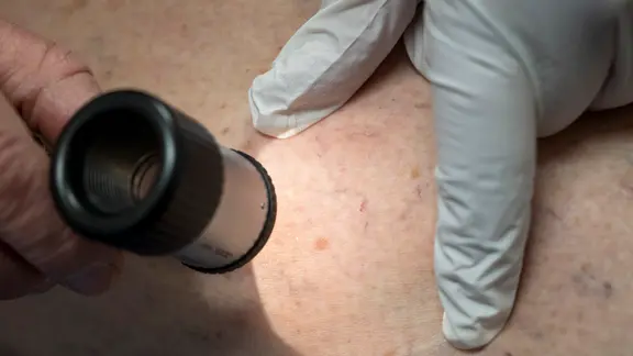 Ein Arzt untersucht in der Praxis die Hautpartie eines Patienten.