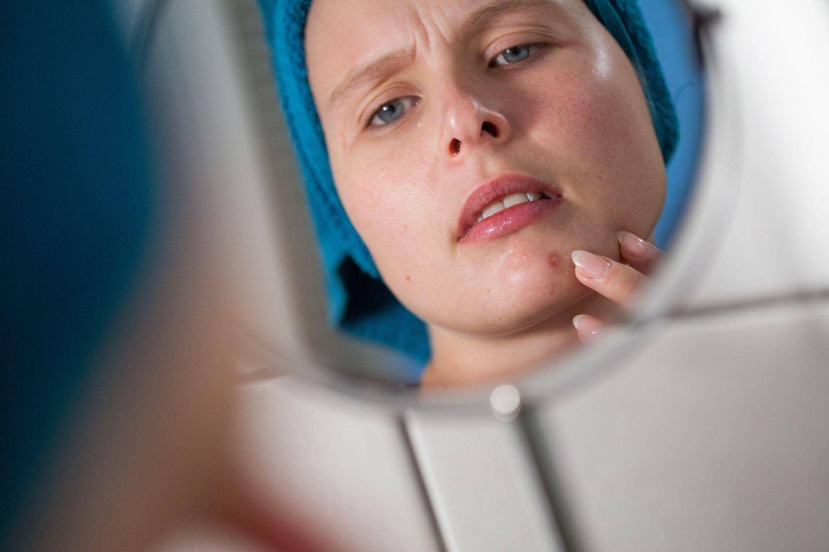 München/Sonthofen | Finger weg! Wie Pickel entstehen - und gut wieder abheilen