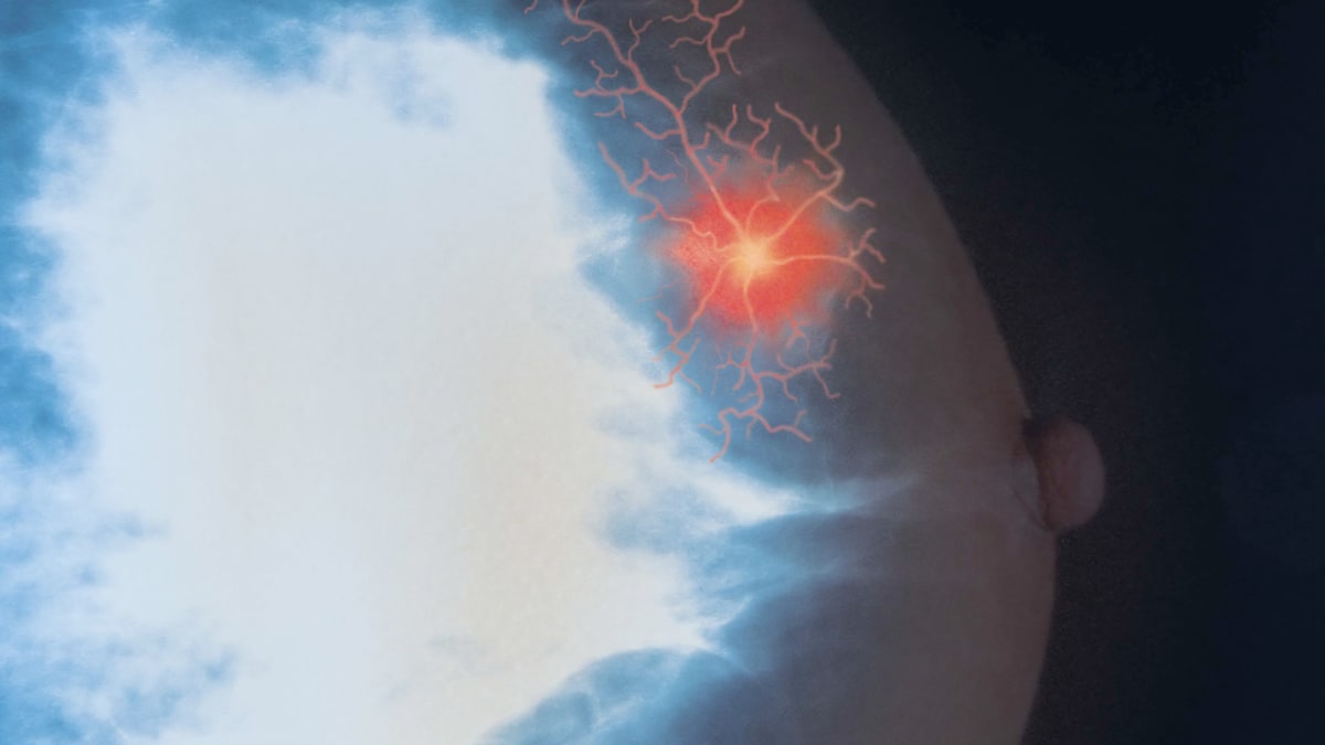 Brustkrebs: Simpler Bluttest soll die Heilungschancen erhöhen