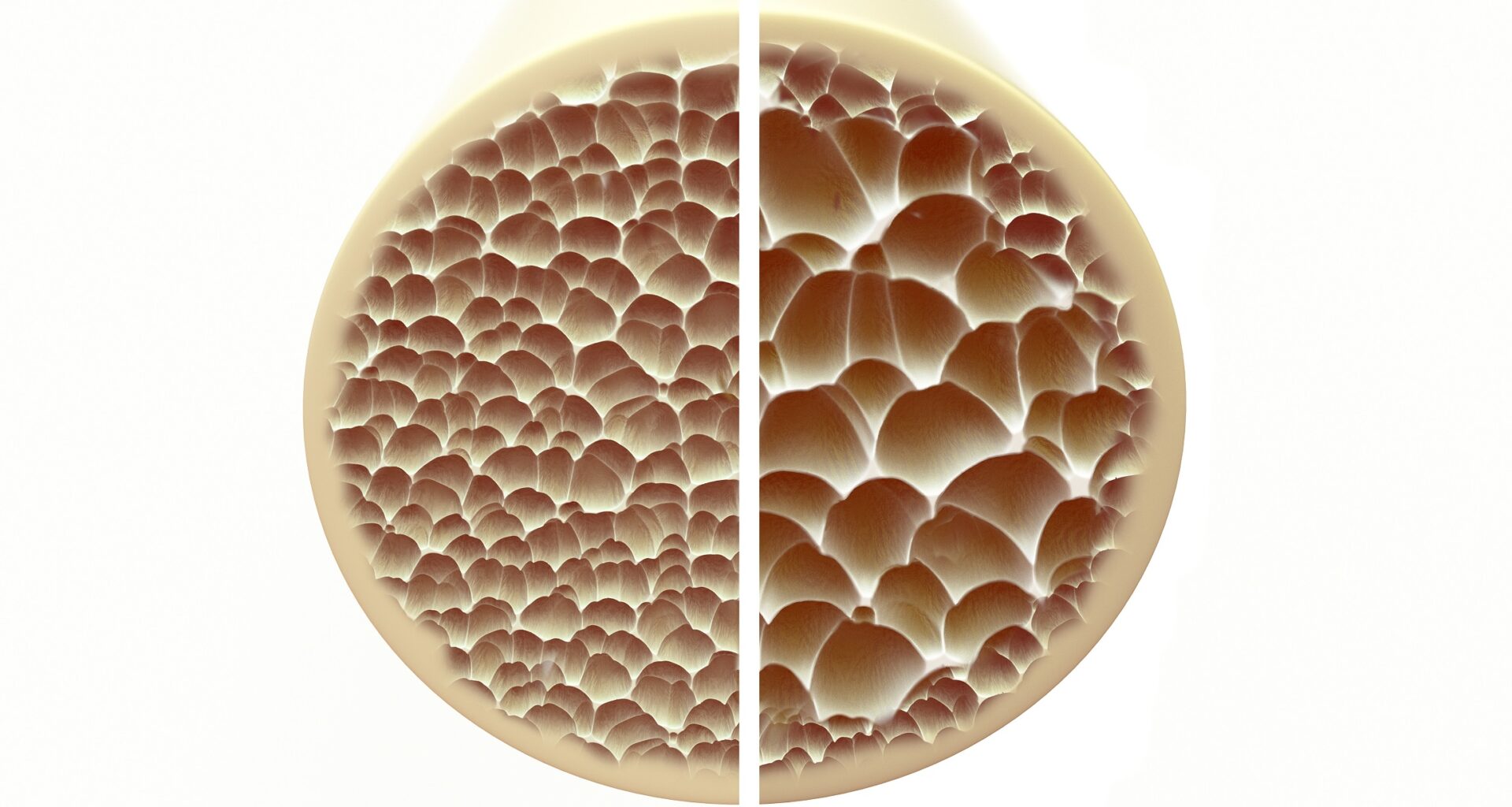 Osteoporose erhöht frühzeitiges Sterberisiko signifikant – Heilpraxis