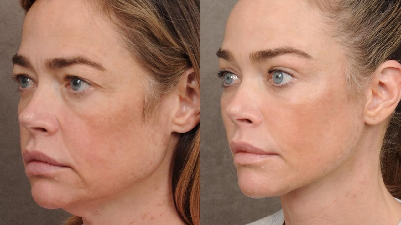 Denise Richards packt über ihr Facelift aus – was sie genau machen ließ | Unterhaltung