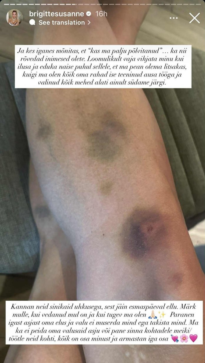 Brigitte näitas oma sinikaid