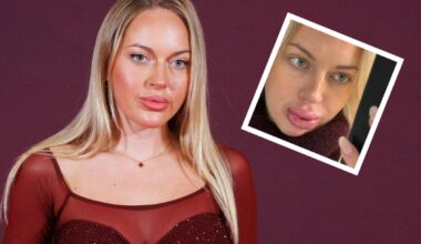 VIDEO | „Ma ei taha neid enam täita.“ Sisulooja Erna Husko huuled läksid pärast täiteaine eemaldamist korralikult paiste