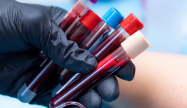 TEADUSTÖÖ PALJASTAB ⟩ Pikaajalise COVIDiga inimestel on veres veider moodustis