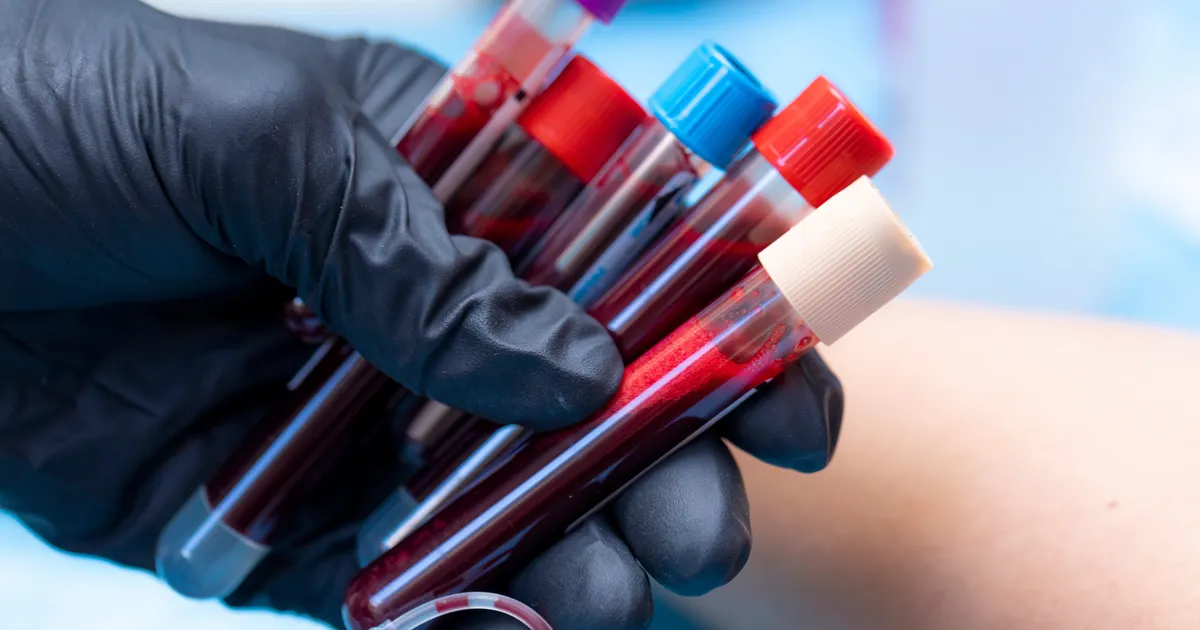 TEADUSTÖÖ PALJASTAB ⟩ Pikaajalise COVIDiga inimestel on veres veider moodustis