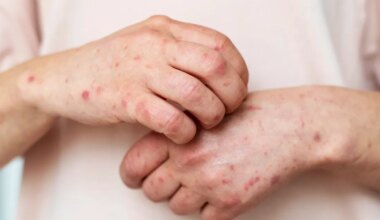 Kanaari saartel levib laastav nakkushaigus – Eestis on olukord veel rahulik