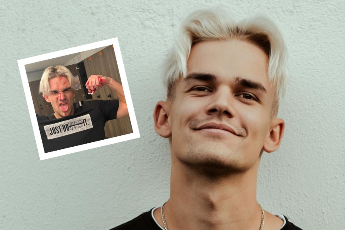 Muusik Rozell murdis padelit mängides ninaluu. „Lõin ise endale reketiga näkku“