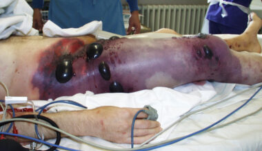 Ukraina sõdurite seas levib jube haigus