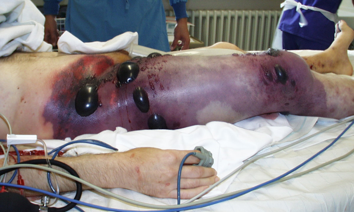 Ukraina sõdurite seas levib jube haigus